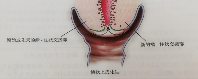 宮頸癌篩查沒那么簡單，這些技巧助你提高取樣質(zhì)量