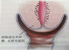 宮頸癌篩查沒那么簡單，這些技巧助你提高取樣質(zhì)量